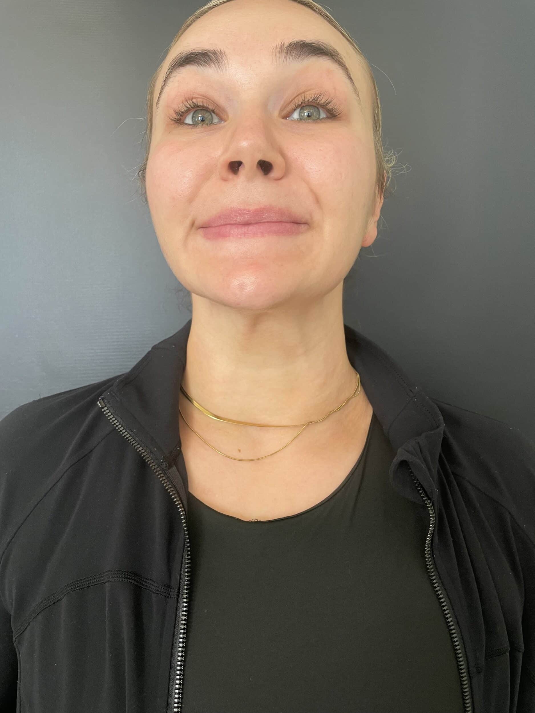 After Image: Nonsurgical Toxin - front