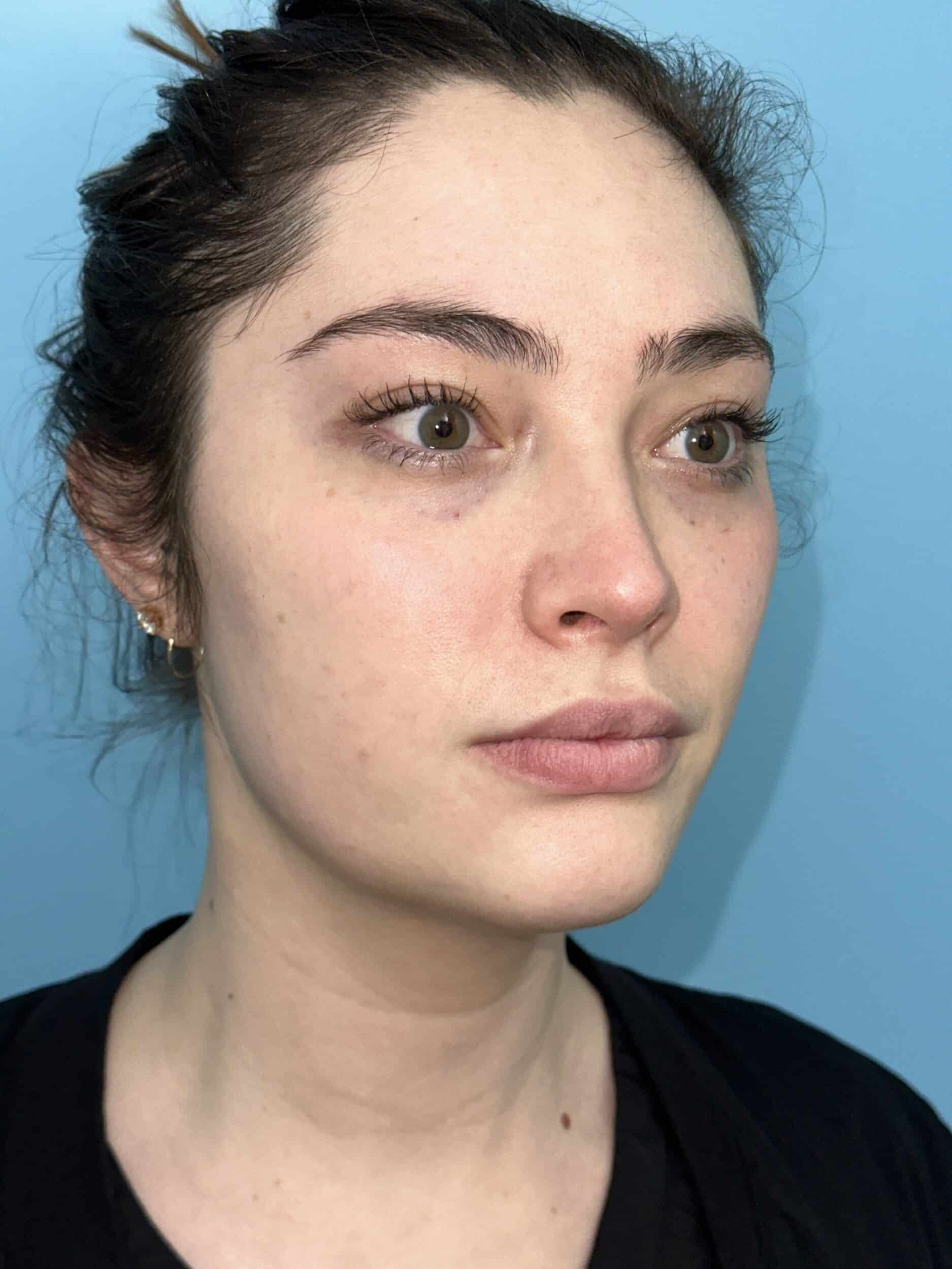 After Image: Eye Filler - front