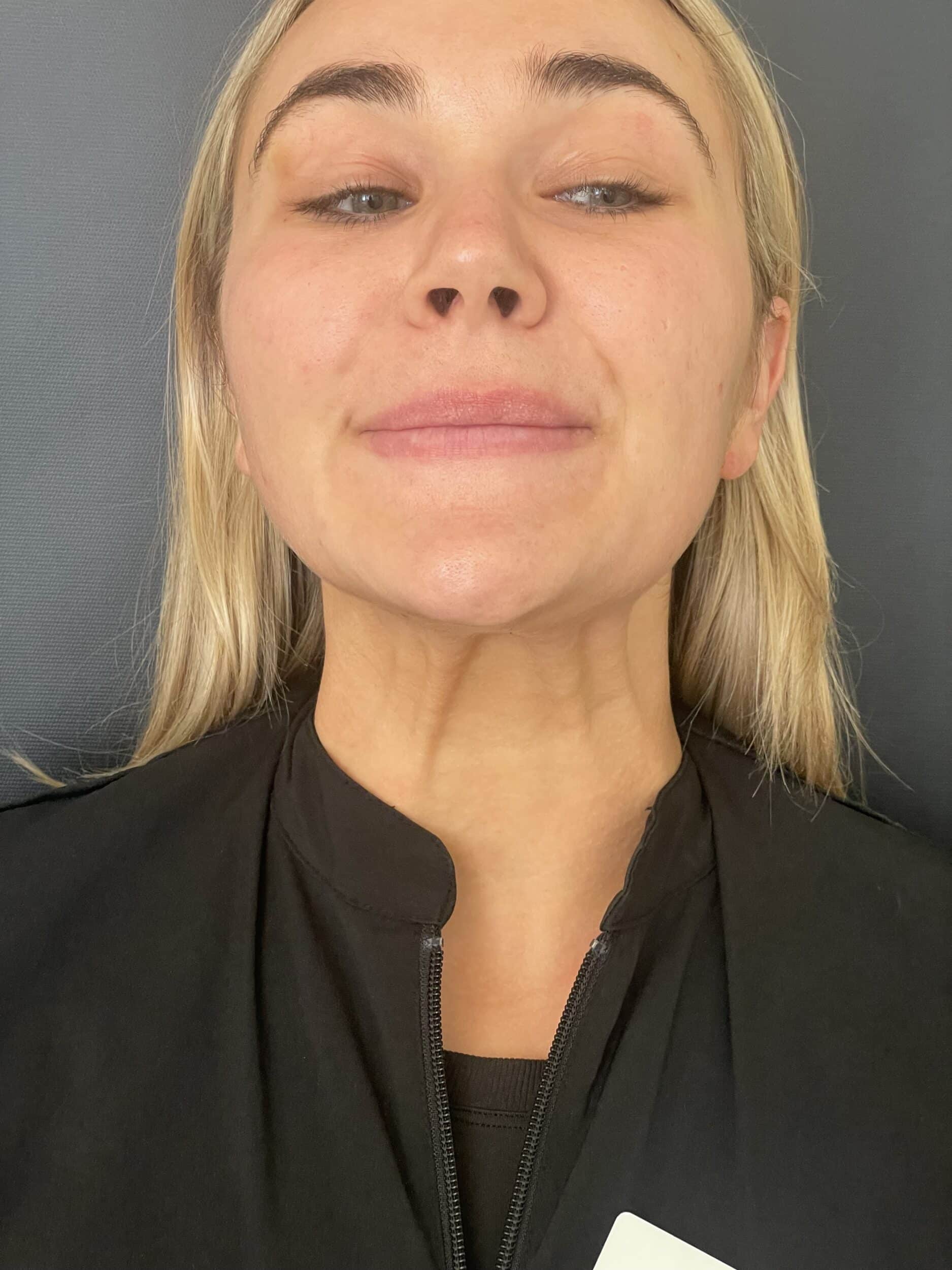 Before Image: Nonsurgical Toxin - front