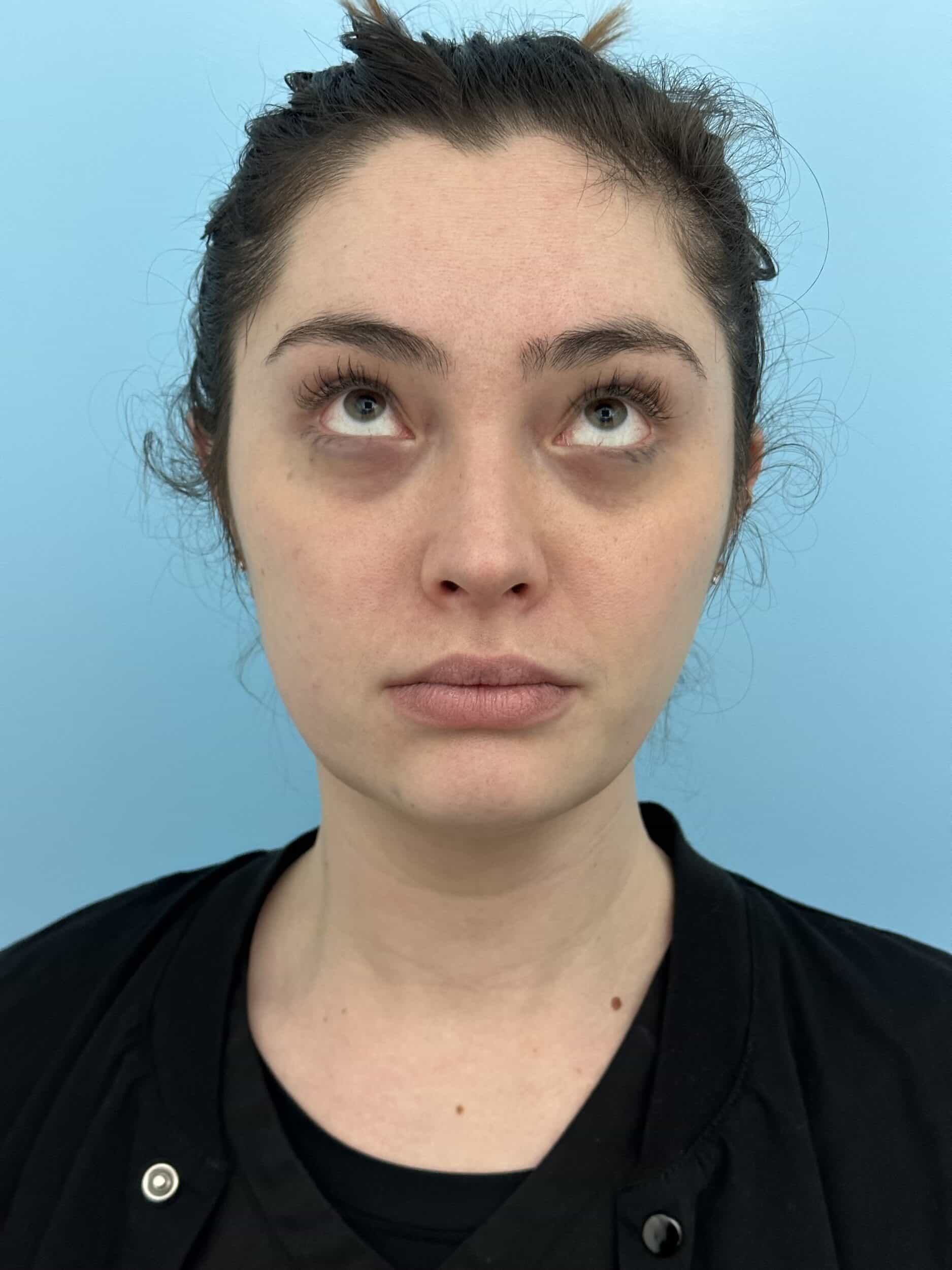 Before Image: Eye Filler - front