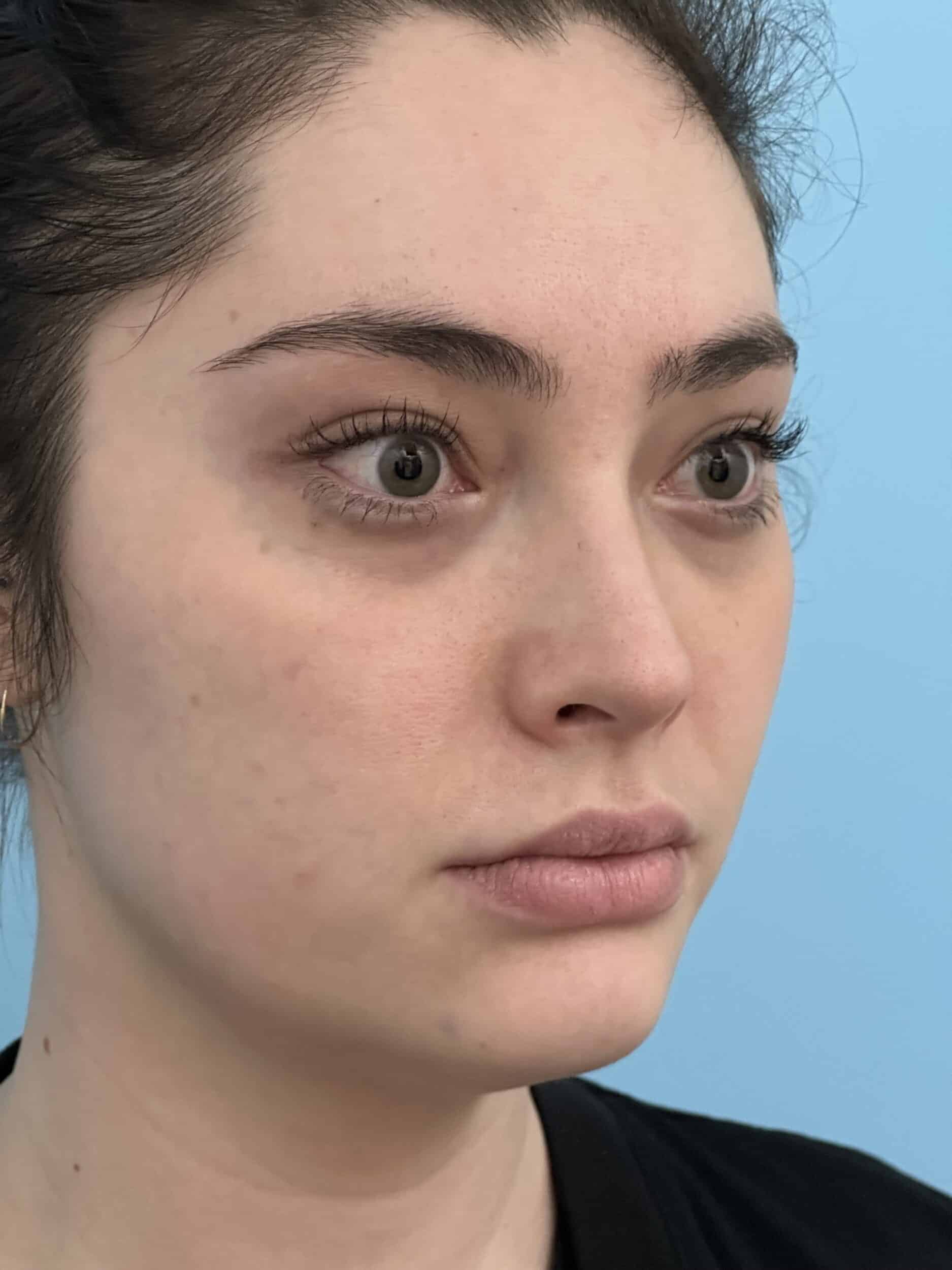 Before Image: Eye Filler - front