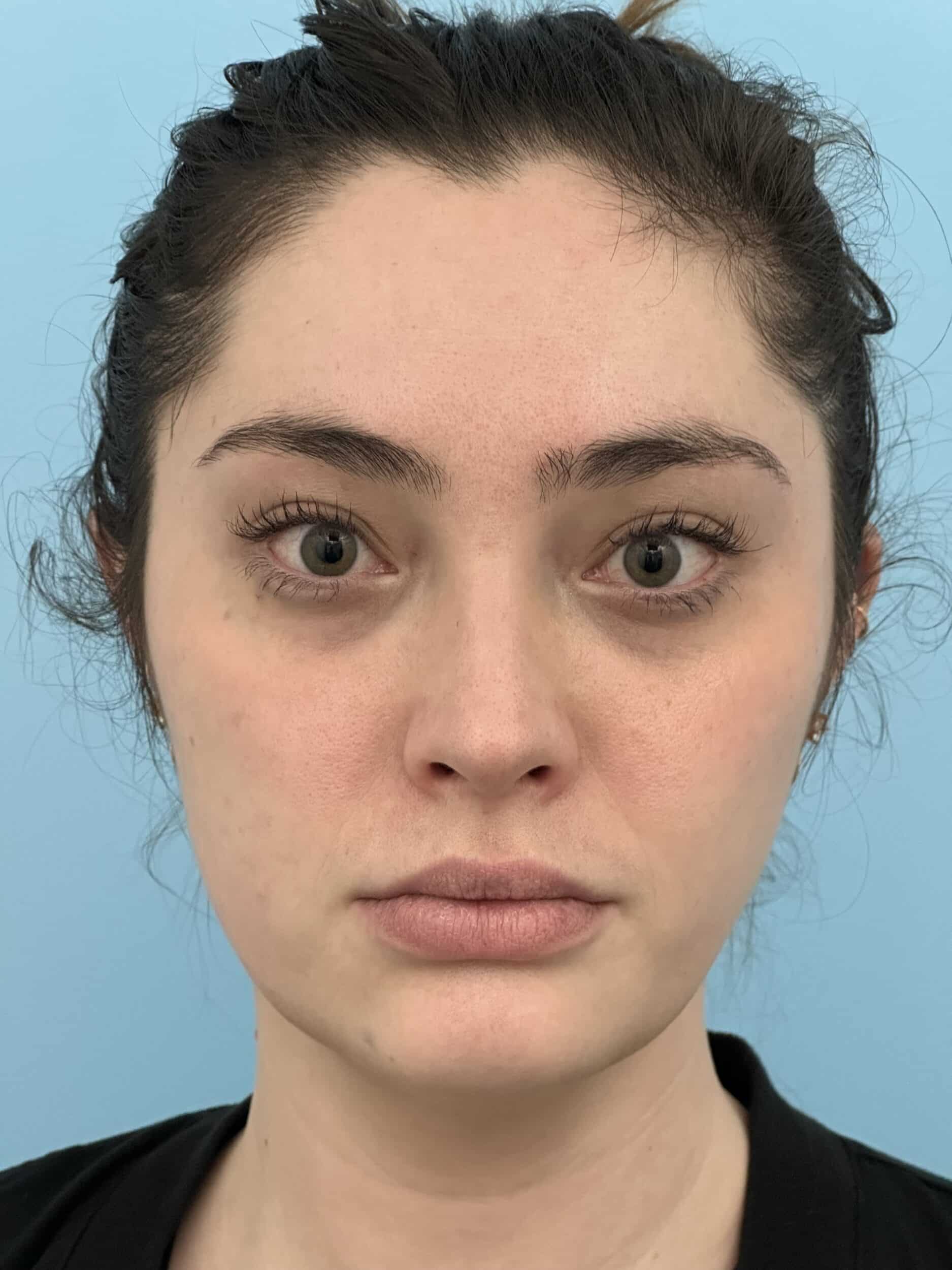 Before Image: Eye Filler - front