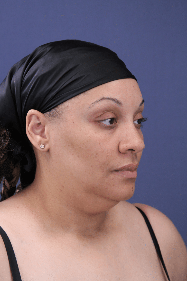 Before Image: Submental Liposuction - front