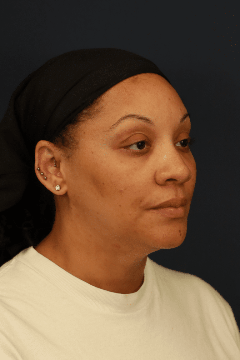 After Image: Submental Liposuction - front