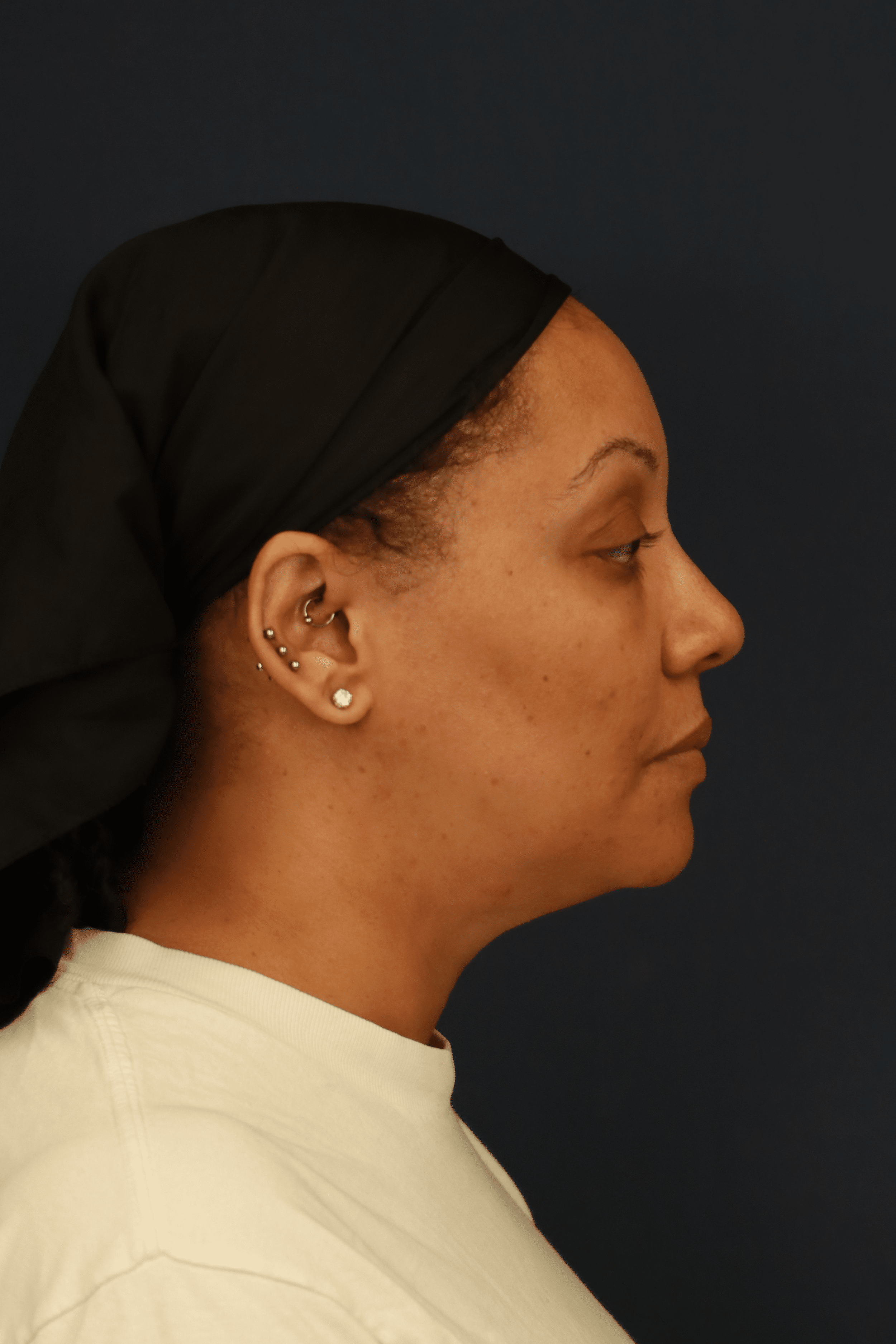 After Image: Submental Liposuction - right-side