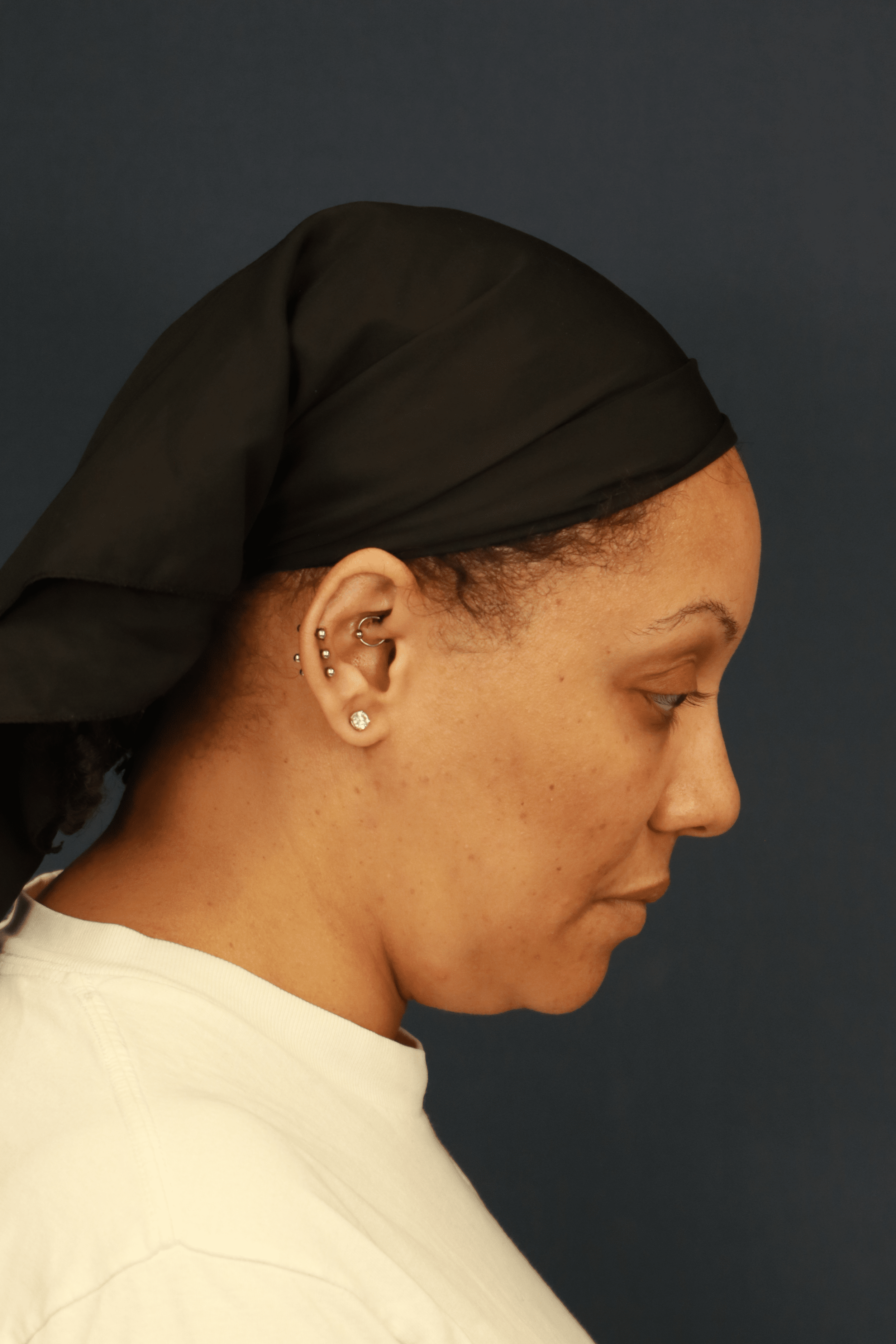 After Image: Submental Liposuction - right-side