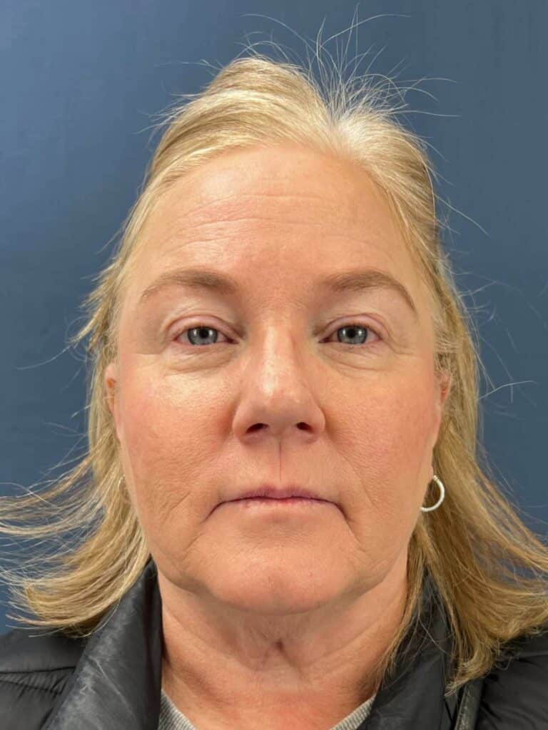 Before Image: Upper Eyelid Lift & Facial Fat Grafting - front