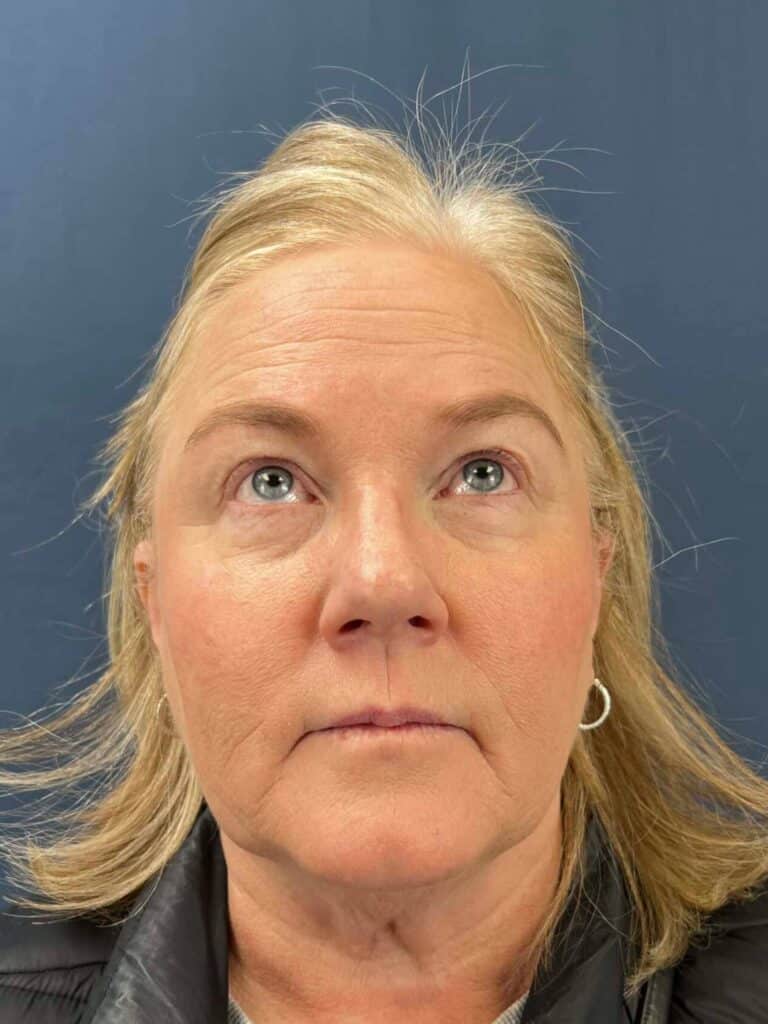 Before Image: Upper Eyelid Lift & Facial Fat Grafting - front