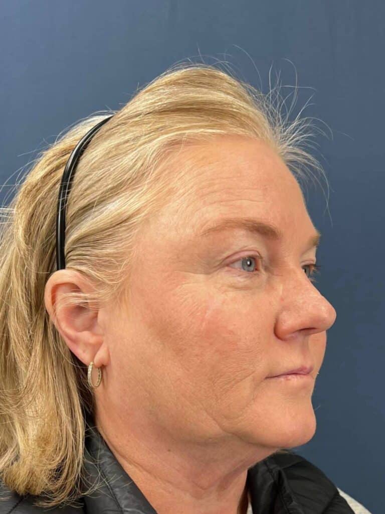 Before Image: Upper Eyelid Lift & Facial Fat Grafting - right-side
