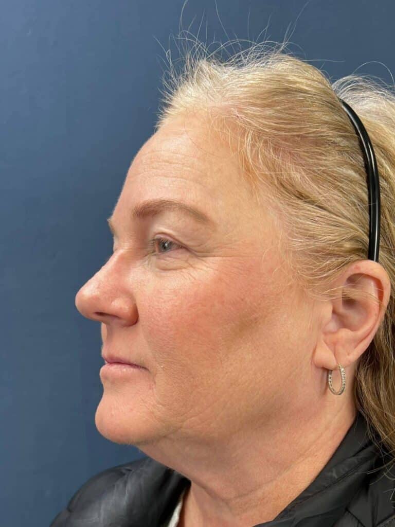 Before Image: Upper Eyelid Lift & Facial Fat Grafting - left-back-oblique
