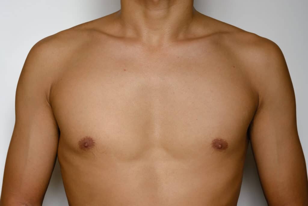 man with flat, sculpted chest after male breast reduction to treat gynecomastia
