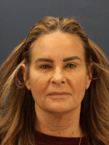 Before Image: Deep Plane Face and Neck lift with Platysmaplasty, Lip lift, Brow Lift, Facial Fat Grafting