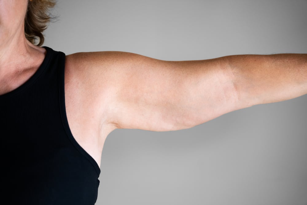 Woman with outstretched are with some excess skin that could be addressed with an arm lift.